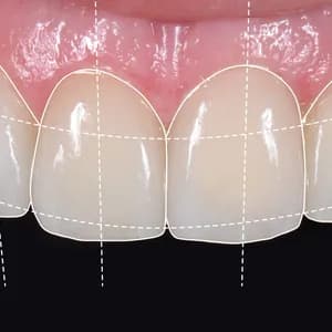 Digital Smile Design: Ihr neues Lächeln am Computer planen