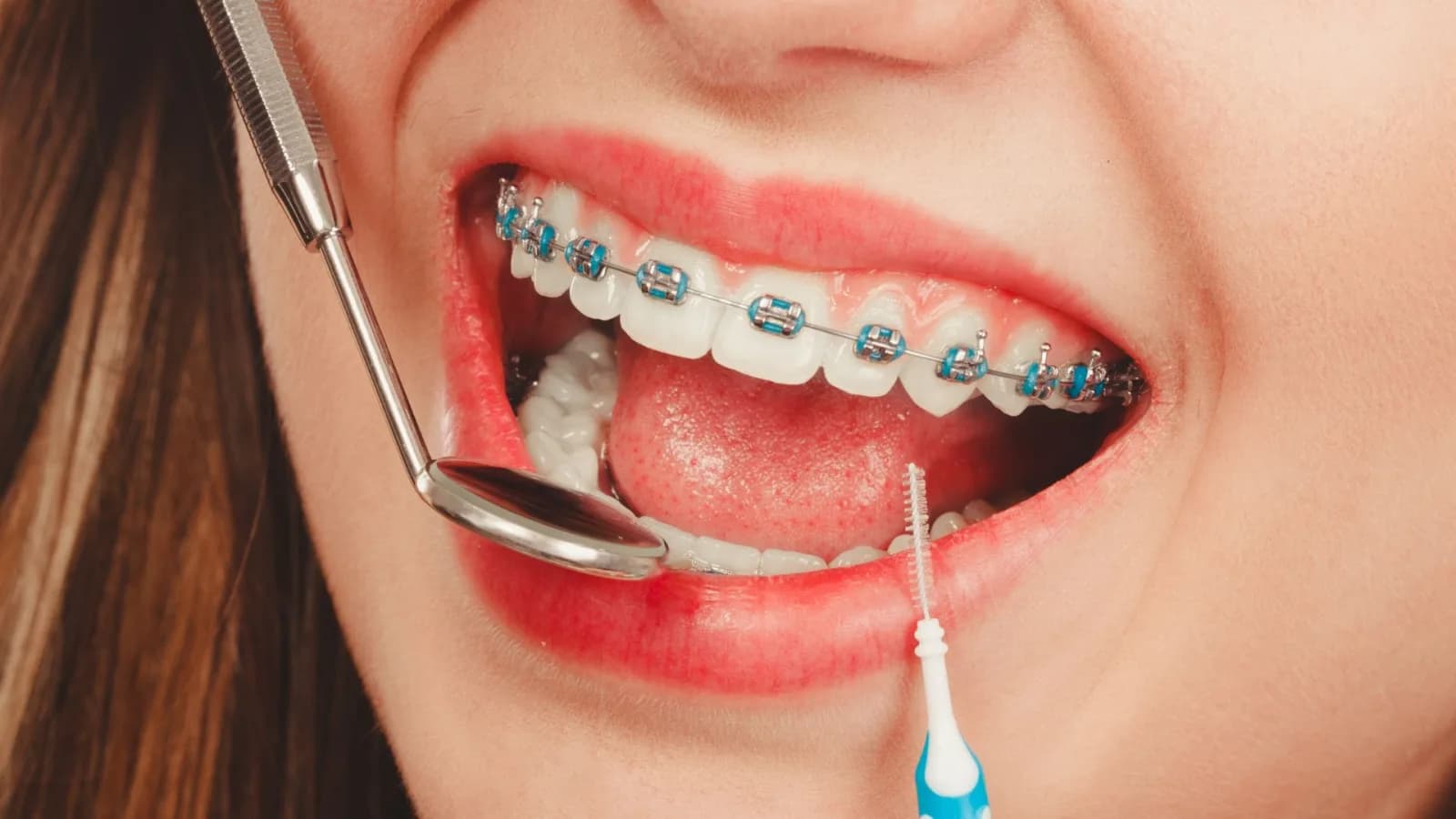 Kieferorthopädie für Jugendliche – der ideale Zeitpunkt für gerade Zähne