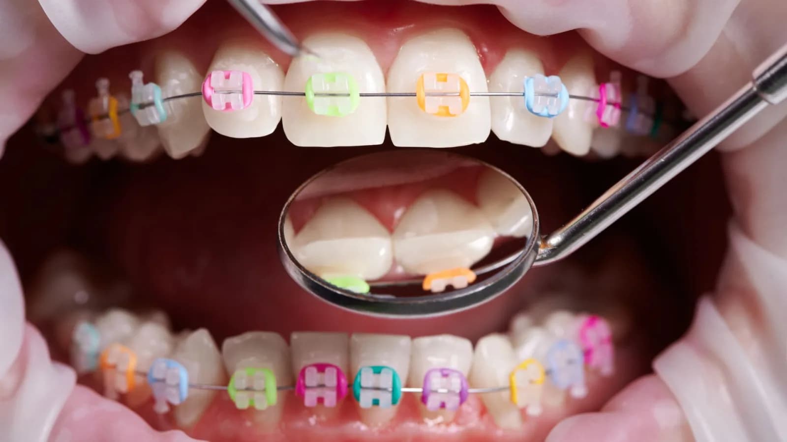 Retainer – das Ergebnis dauerhaft sichern