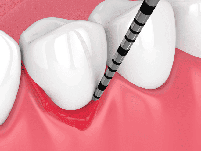 Was ist Parodontitis bzw. Parodontose & Gingivitis bzw. Zahnfleischentzündung?